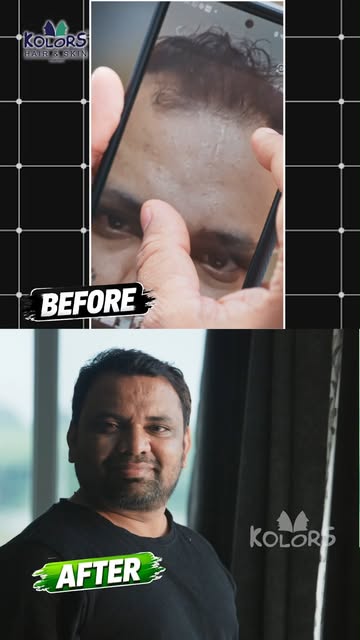 “Hair loss was affecting my confidence, work and everyday life.” ✨

Ayash shares his hair restoratio