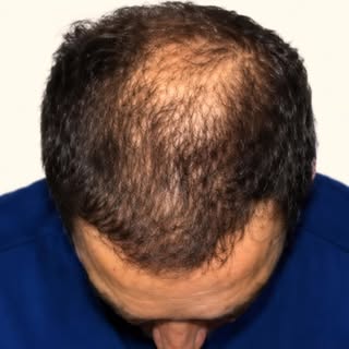 #fue #hairtransplant #drmeena #genevehairclinic #style