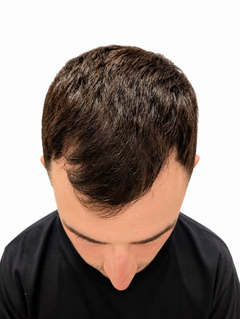 1300 grafts to temporal corners tracking into central hairline
7 months growth. Extremely pleasing t