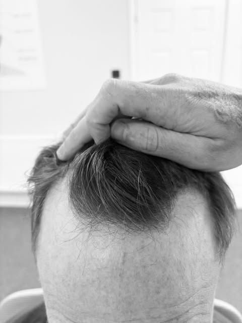 A hair transplant isn’t just about filling in the empty areas.

A great result should look natural, 