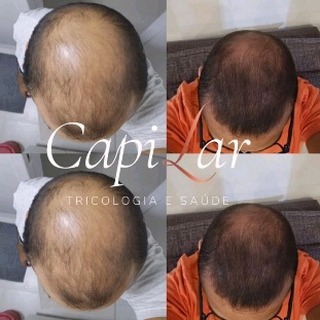 Vamos relembrar alguns casos? 
Você não precisa ficar calvo!
#alopeciaandrogenetica #calvicie #trico