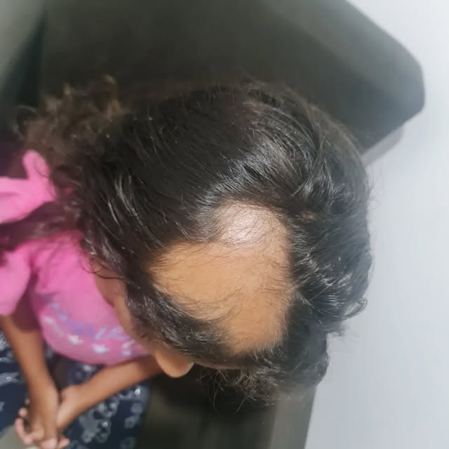 ✨ Que resultado lindo! ❤️

Alopecia Areata em criança. 🥹

Um dos trabalhos que mais amamos realizar