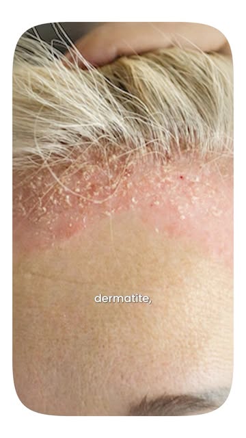 Nem toda descamação é apenas “caspa comum”! 🛑👇
Você já trocou de shampoo várias vezes e as casquin