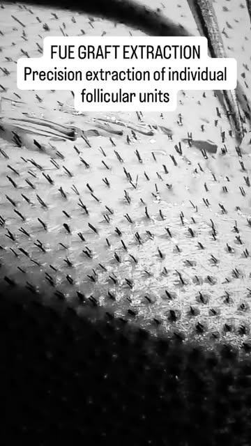How are hair grafts extracted during an FUE hair transplant? 🔬

During the FUE (Follicular Unit Ext