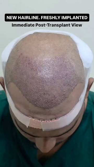 ✨ A new hairline begins with precision placement.

This video shows an immediate post-operative view
