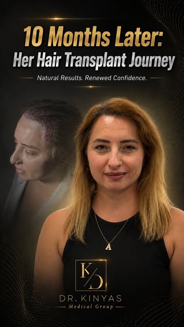 10 months after her hair transplant… and this is how she describes the journey. ✨

For many women, h