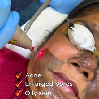 Carbon Laser Peel also known as Hollywood peel is a superficial treatment that helps with acne, enla