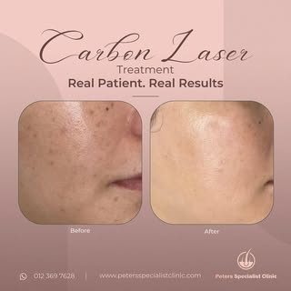 Unveiling the magic of Carbon Laser: ✨ Witness the transformative journey from pigmentation and enla
