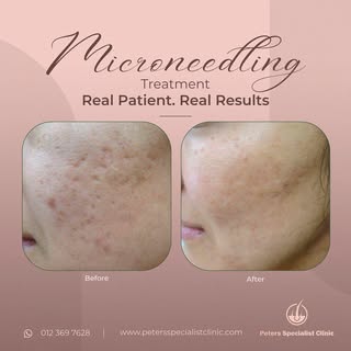 Check Out These Incredible Microneedling Before and After Results! Witness the Transformation and Di