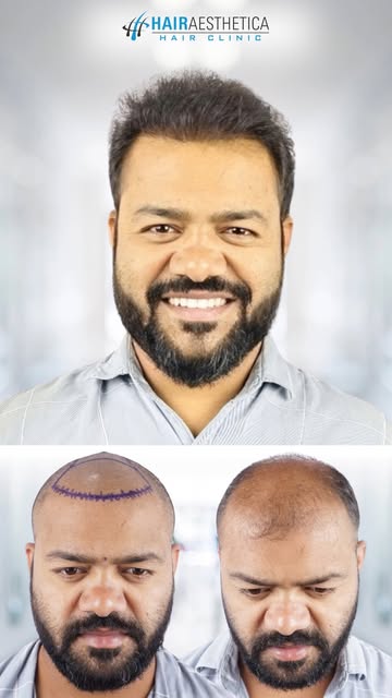 Because great restoration should never look obvious.

Tags: natural looking hair, hair growth, hair 