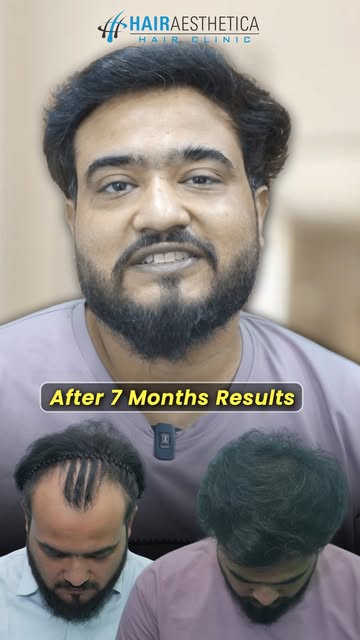 Creating personalised hair restoration journeys with precision and care.

Tags: natural looking hair