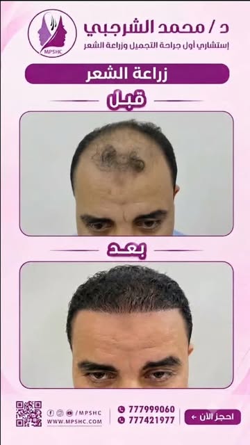 🔥 الفرق الذي تتحدث عنه الصورة، لا يحتاج إلى شرح

من فراغات واضحة في مقدمة الرأس إلى خط شعر أكثر امت