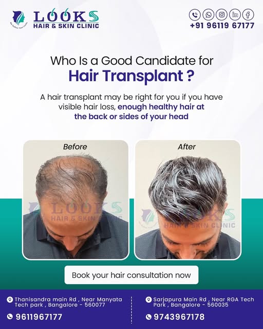 Hair loss affecting your confidence? 💇‍♂️✨
A hair transplant may be an option if you have visible h