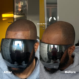 From NANTES to Khevdy Paris 🇫🇷🌎 Avant/Après SMP STYLE AMÉRICAIN. Protocole personnalisé entièreme