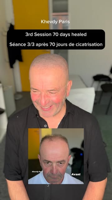 SMP séance 3/3 après 70 jours de cicatrisation. Témoignage client 🔈. Protocole et suivi personnalis
