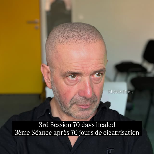 SMP style européen séance 3/3 après 70 jours de cicatrisation . Protocole et suivi personnalisé du d