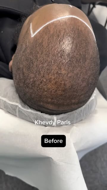 SMP DENSITÉ ET RESTAURATION DES CONTOURS ✅. Cas complexe sur peau foncée, sans raser les cheveux exi