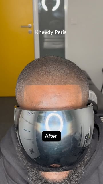 SMP DENSITÉ ET RESTAURATION DES CONTOURS ✅. Cas complexe sur peau foncée, sans raser les cheveux exi