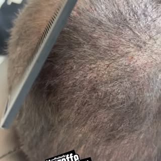 •	Première séance de densification en tricopigmentation ✨
Un effet de densité visible dès la premièr