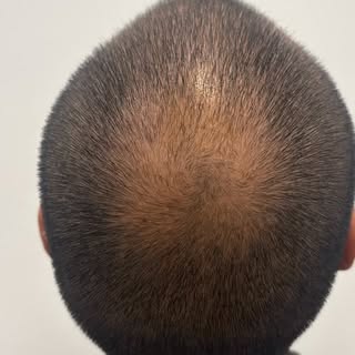 La tricopigmentation redonne instantanément un effet de densité naturel, sans chirurgie et sans évic