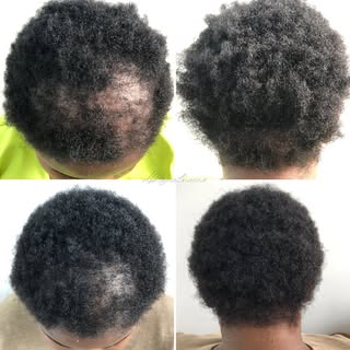 2 months regrowth.  The journey continues 

#hairloss #hairlosstreatment #trichologyclinic #abujahai