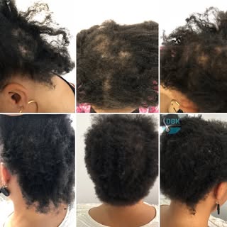 Regrowth ✅

#hairloss #hairlosshelp #trichology #abuja #hairlossabuja #trichologistabuja