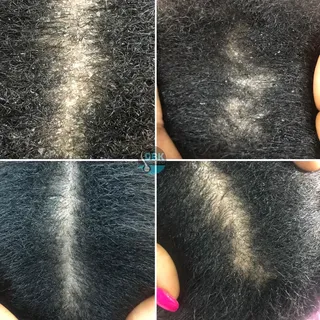 Befor an after  session.

Your flaky  scalp can be cleansed without using harsh products and sharp o