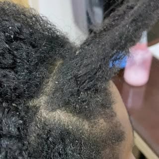 We did not scratch the flakes off her scalp with tools that can cause sensitivity or bleeding. 

Wit