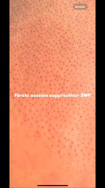 Första sessionen av SMP 🔥

Redan efter första behandlingen ser man en tydlig skillnad – en mjuk och
