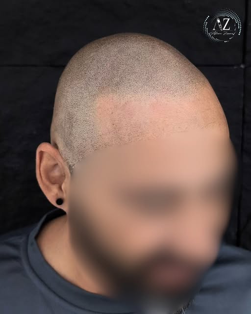 Otro cliente más satisfecho con su sesión de micropigmentación capilar. ¡Desliza para ver cómo se ve
