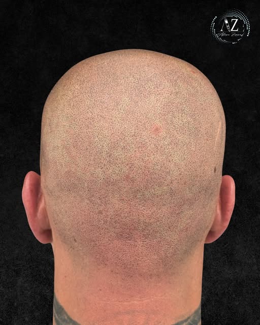 ¡Cambios que hablan por sí solos! Desliza para ver el antes y después.

Cada caso de alopecia es dif