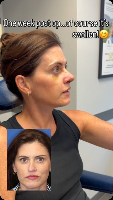 Revision Rhinoplasty with multiple grafts from rib and remnant nasal septum. Patients are ALWAYS mor