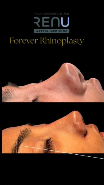 Some revision rhinoplasty surgeries are just more difficult. This incredible young woman came to me 