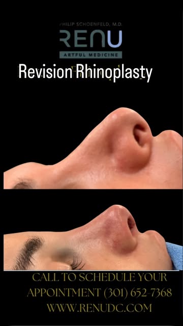 Revision rhinoplasty on one of the nicest patients.  She waited a decade until she found the right R
