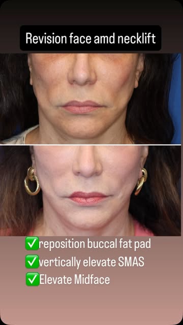 Facelifts sometimes appear to look odd because of several issues. My lovely patient had her facelift