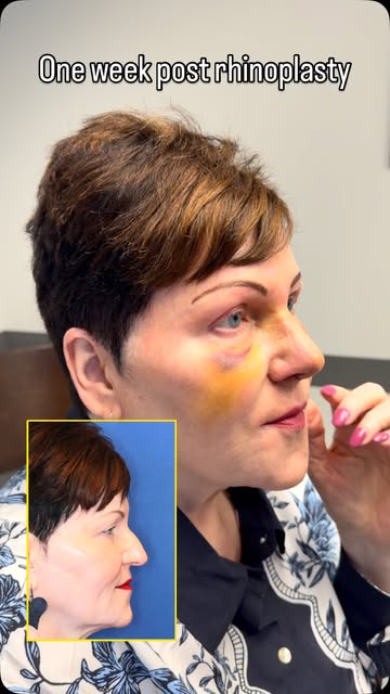 Yes, she is bruised one week following rhinoplasty! But, super happy with a nose she has literally w