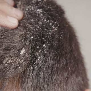 Usar o shampoo anticaspa apenas quando a descamação surge, não deixar o produto agir no couro, aplic