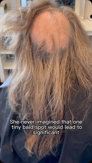 💔 What started as one small bald spot became significant hair loss in just five months.

For our cl
