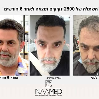 תוצאה כזו לא משאירה הרבה מילים🤩

עוד עבודה מוצלחת של מרכז השתלות השיער- Inaamed✨
מטופל שעבר השתלת ש