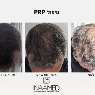 עוד עבודה מוצלחת של מרכז השתלות השיער- Inaamed✨
והפעם מטופל שעבר טיפולי PRP לחיזוק ושיקום זקיקי השער