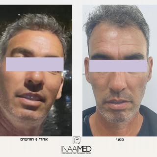 עוד עבודה מוצלחת של מרכז השתלות השיער- Inaamed✨
מטופל שעבר השתלת שיער עם ד׳ר עומר בושאם.

👈מתעניין 