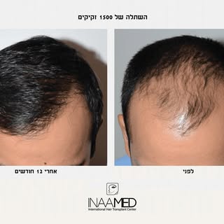 תוצאה נפלאה לפנינו 😌
עבודה נוספת של מרכז השתלות השיער-  Inaamed ✨
מטופל שעבר השתלת שיער של 1500 זקי