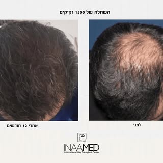 עבודה מדהימה נוספת של מרכז השתלות השיער-  Inaamed ✨
מטופל שעבר השתלת שיער של 1500 זקיקים עם ד׳ר עומר
