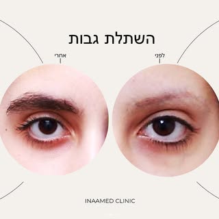 עבודה מדהימה לפנינו
 של השתלת שיער בגבות במרכז השתלות השיער-  Inaamed ✨

👈מתעניין או מתעניינת בהשתל