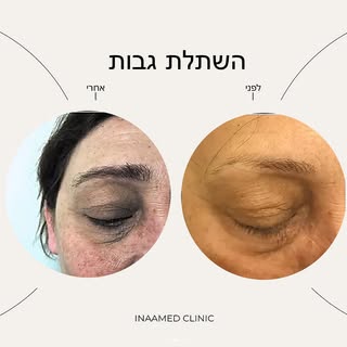 עבודה נוספת לפנינו
 של השתלת שיער בגבות במרכז השתלות השיער-  Inaamed ✨

👈מתעניין או מתעניינת בהשתלת