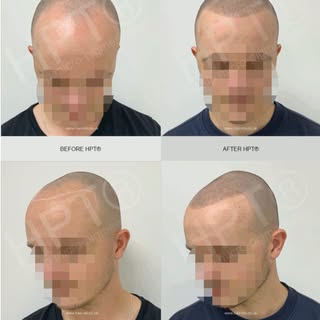 Scalp Micropigmentation Before & After. Creating the illusion of #shavenhead with texture using HPT®