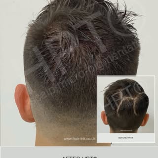 Camouflage of trauma scar using HPT® scalp micro-pigmentation. #scalpmicropigmentation is the ideal 