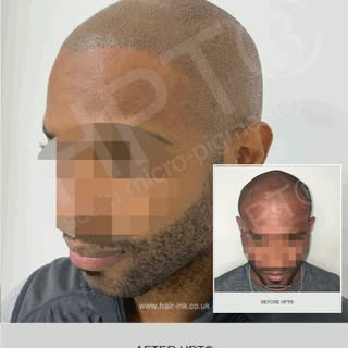 Creating the illusion of #shavenhead with texture using HPT®  #scalpmicropigmentation. Additional re