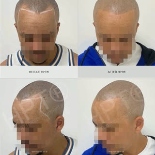 Scalp Micropigmentation Before & After. Creating the illusion of #shavenhead with texture using HPT®