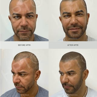 Using HPT®  #scalpmicropigmentation to restore  #hairline and create the illusion of more consistent